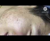 Hoang My Acne Treatment