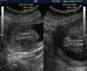 This is the latest ultrasound. This time we are pretty sure its a girl. The video is about 14min and at the end, the doctor uses the cursor to indicate where to look for the sex of the baby. It seems to be a girl. Were thinking of naming her Francesca Lee.nfor family use.
