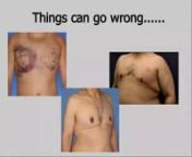 How to get rid of man boobs: http://www.themanlyzone.com/nnTreating GynecomastianIf you are a boy, a young man or a mature man and you haveGynecomastia also known informally as ‘man boobs’, chances are that you have been looking high and low for a solution to this problem sometimes it is just embarrassment.Sometimes it is embarrassment added to pain and tenderness where the glandular tissue has grown abnormally. The first step, as always in medical issues, consult your doctor who will gi