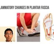 PLANTER FASCIITIS PRIVIEW from priview