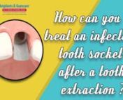 How can you treat an infected tooth socket after a tooth extraction? - by Implants &amp; Gumcare, Texas - Q &amp; A session with Dr Kumar T. Vadivel DDS, FDS RCS, MS. Implants &amp; Gumcare Dental Q &amp; A Live Stream Excerpt from Dallas - Fort Worth area, Texas.