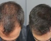 Paciente de 30 años en tratamiento con finasteride/dutasteride alterno y alopecia difusa (DPA) que marca un NW IV.nnCaracterísticas donante:nn· Temporal: 56 micras de pelo; 98 UF/cm2; 196 pelos/cm2; 2,00 pelos/UF; CV de 10,98n· Parietal: 58 micras; 102 UF/cm2; 228 pelos/cm2; 2,24 pelos/UF; CV de 13,22n· Occipital: 60 micras; 91 UF/cm2; 228 pelos/cm2; 2,51 pelos/UF; CV de 13,68.nTDA (área donante total) de 275 cm2y TDC (capacidad donante total) de 15159 grafts (a 2,25 pelos/graft).nnSe re