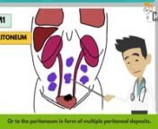 In this video, CancerBro will explain bladder cancer TNM staging in detail. Watch the video to better understand different stages of bladder cancer. nnVideo Transcript:nnConsider this to be a cross section from the wall of the urinary bladder, with the upper part being the inside of the wall and lower part being the inside of the wall and lower part being outside.nnThe innermost layer is called epithelium outer to which lies this layer called as lamina propria. nnOuter to lamina propria lies thi