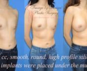 Considering natural breast augmentation in in Port Huron MI   Contact Dr Melek Kayser of Image By Design Plastic Surgery https://www.imagebydesignmd.com/ Cosmetic Surgery: great Advice Your Doctor Wants You To Know It is not unfamiliar to tone trepidatious more or less having cosmetic surgery. There are many questions you may have, or concerns that are plaguing you. The key to making the best decisions is knowledge. in the same way as the right guidance and advice, bearing in mind you will look