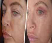 A beautician spent £1.2k on surgery to have her upper eyelids partially removed - so she can apply eyeliner properly. &#60;br/&#62;&#60;br/&#62;Gemma Gilfoyle, 39, hated her hooded eyes - excess skin covering the upper eyelid - for as long as she could remember. &#60;br/&#62;&#60;br/&#62;Having worked in the make-up industry for 19 years, Gemma couldn’t help comparing herself to the women she was doing make-up for. &#60;br/&#62;&#60;br/&#62;She paid £1,270 to get her excess skin removed in Amsterdam, the Netherlands - but has been left with a 2in scar behind her right eye while it heals.&#60;br/&#62;&#60;br/&#62;But Gemma has no regrets and says she&#39;s &#92;